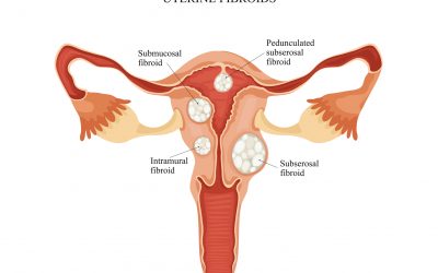 Keep the uterus, get rid of the fibroids