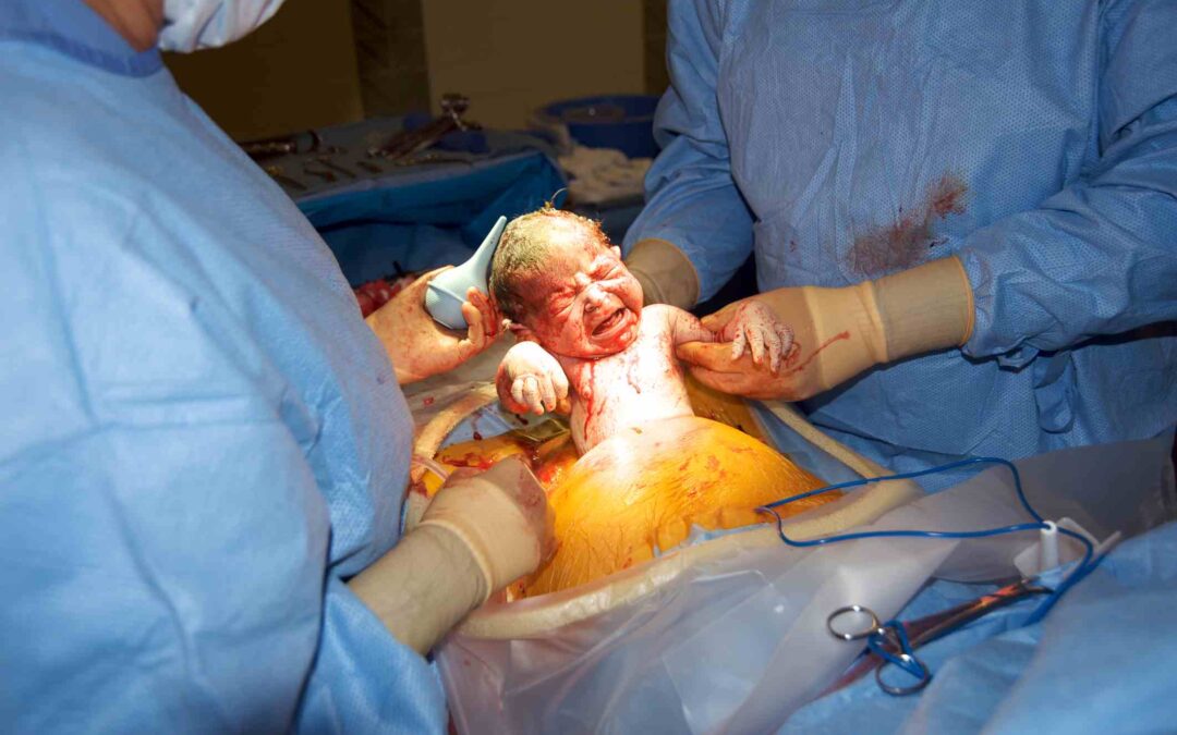 What You Can Do to Avoid a Cesarean
